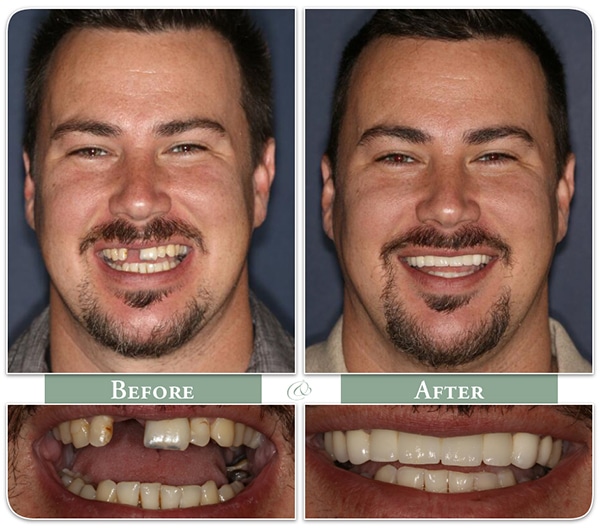 PITTSBURGH DENTAL IMPLANTS BEFORE AND AFTER