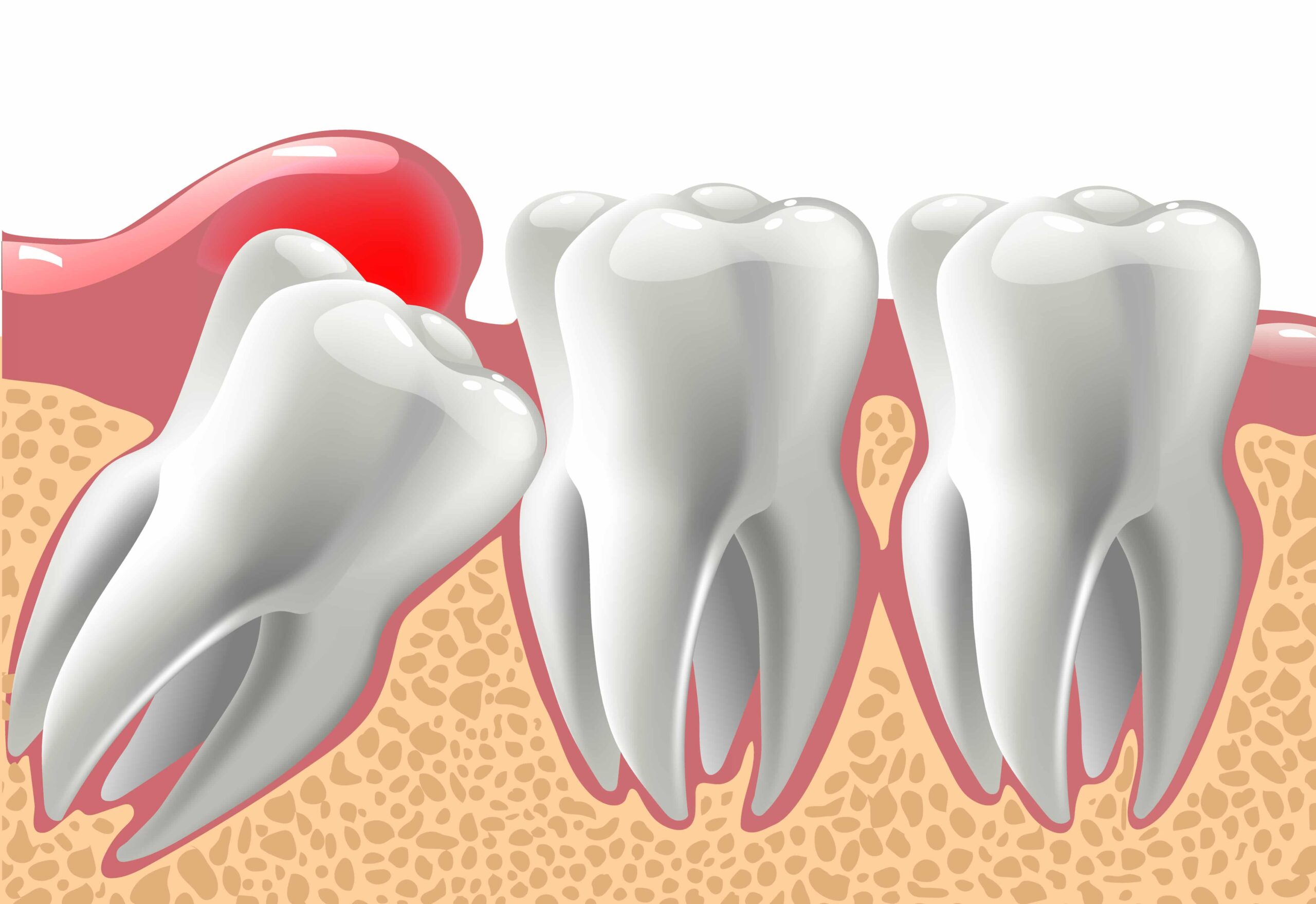 Pittsburgh Wisdom tooth extraction