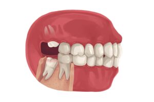 Pittsburgh Wisdom teeth removal
