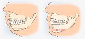 corrective jaw surgery pittsburgh