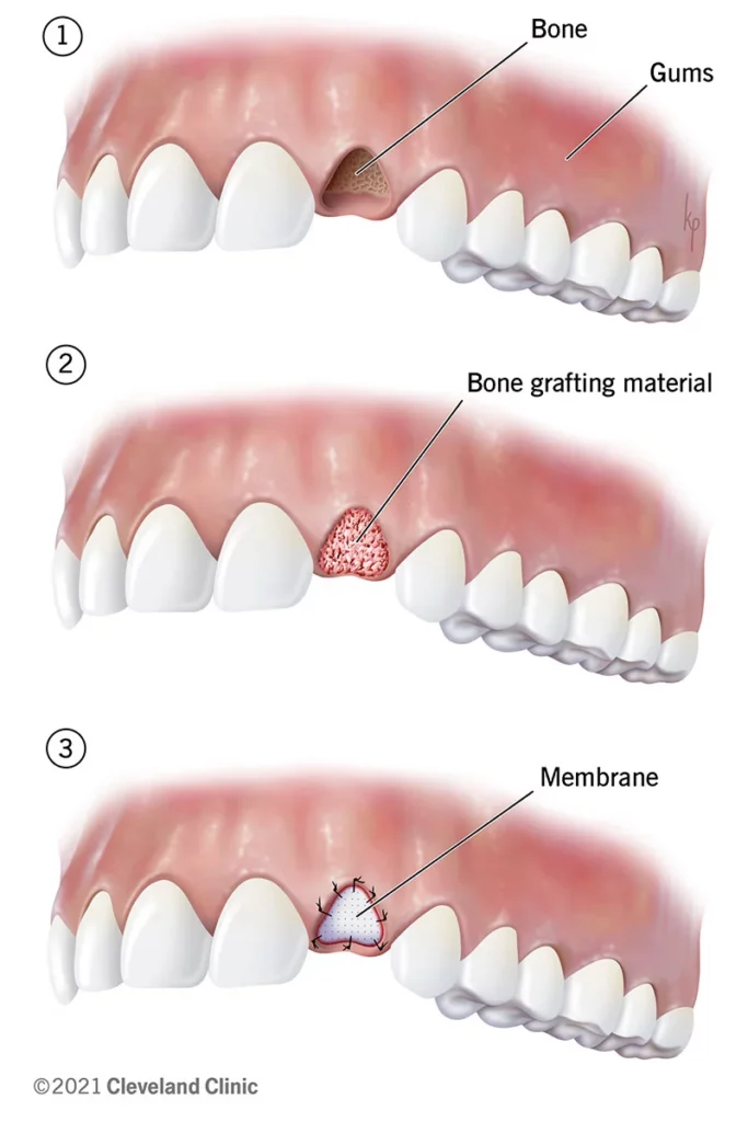 gum graft healing stages