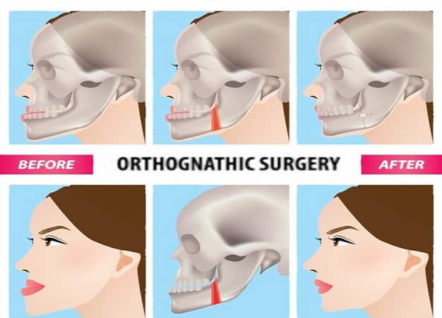 pittsburgh jaw surgery